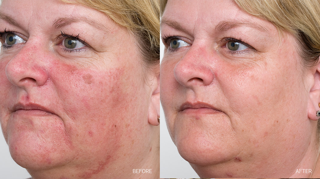 Nordlys Before and After Images 2